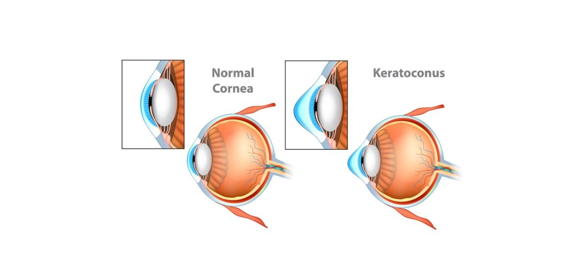 Lentes de Contato