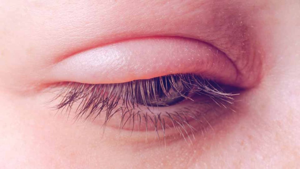 Edema Palpebal (Inchaço da Palpebra)